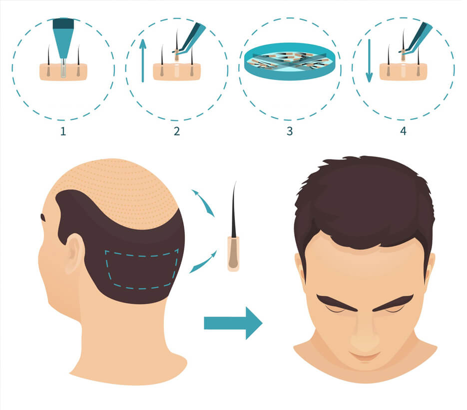 How is Hair Transplant Performed with FUE Technique?