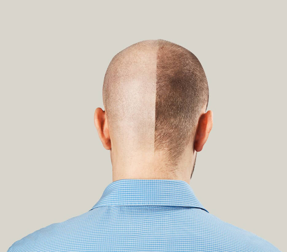 When Can You See Hair Transplant Results?