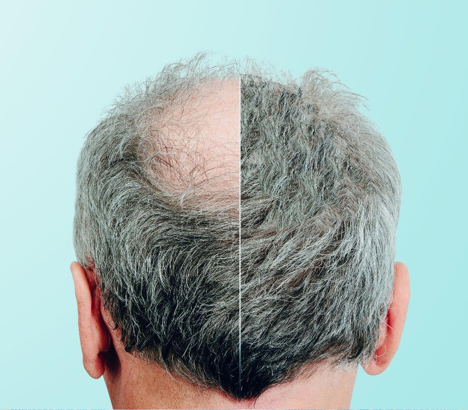 About Post Hair Transplant Process
